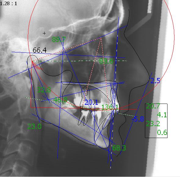 Цефалометрический анализ рентгенограммы черепа и эстетический анализ профиля лица