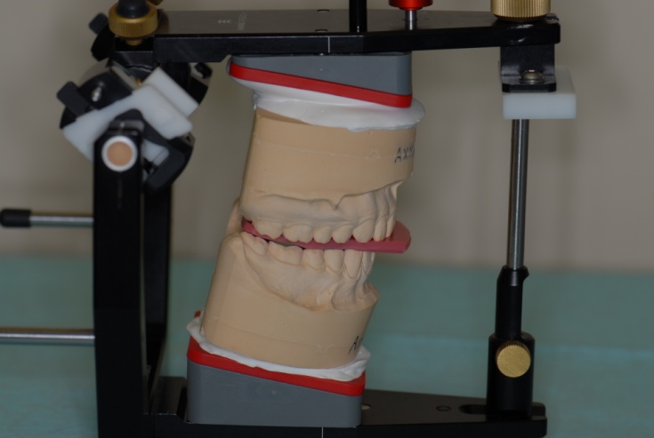 Наложенная на голове пациента анатомическая лицевая дуга и модели, установленные в артикулятор